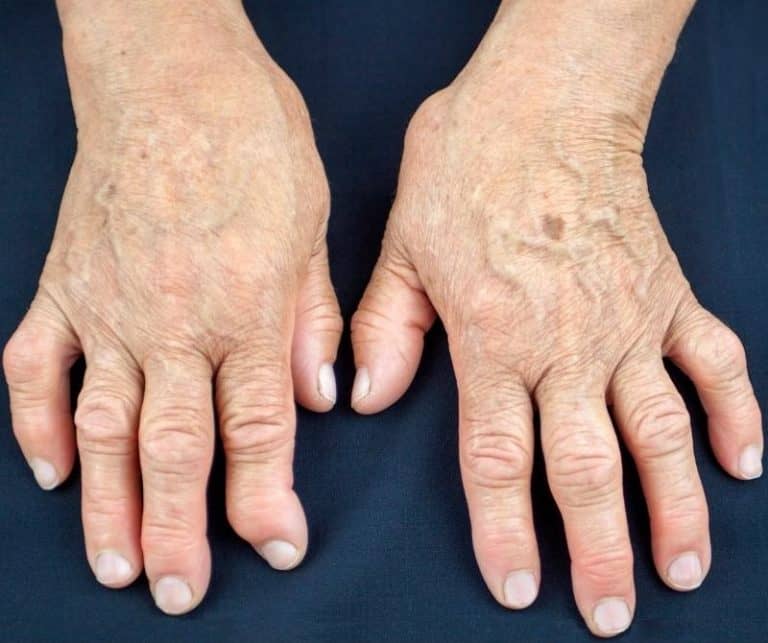 Rheumatoid Arthritis in ICD-10-CM: It’s All in the Joints