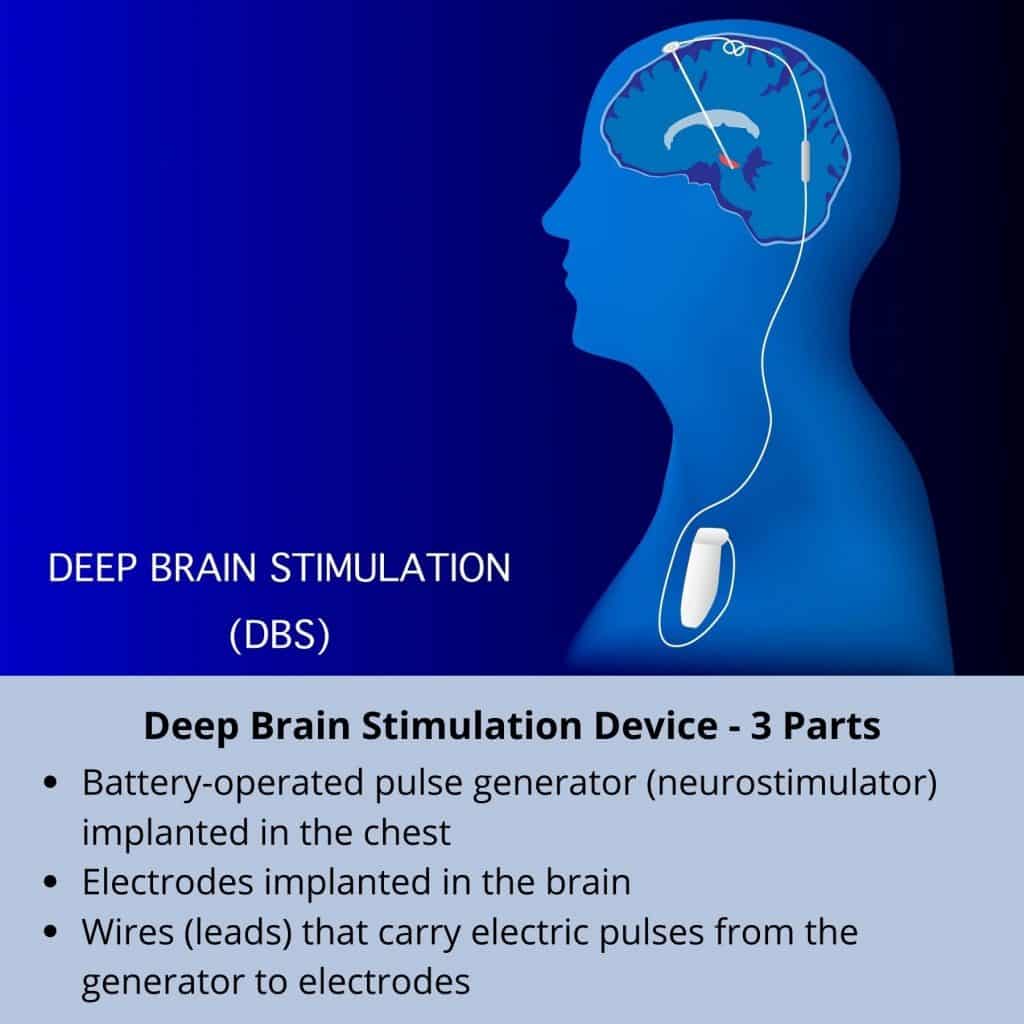 3 main parts of a Deep Brain Stimulation system