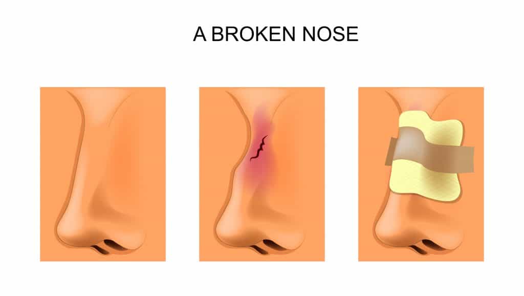 3 images of noses. From left: normal shaped nose; middle: nasal bone fracture; right: external splint applied after reduction 