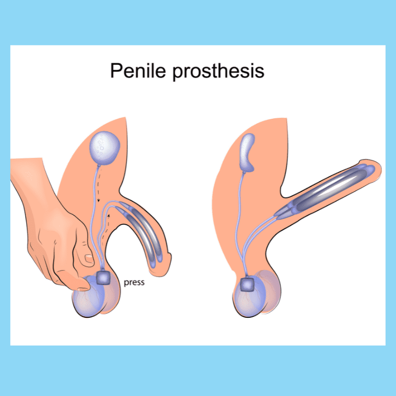 image of a penile prosthesis