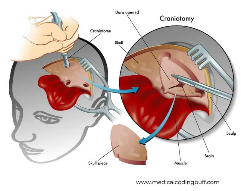 craniotomy procedure where the bone flap is removed and then returned to its location and craniotomy and craniectomy coding